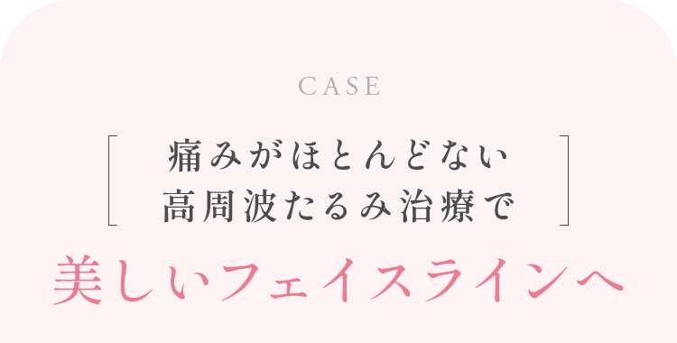 痛みがほとんどない高周波たるみ治療で