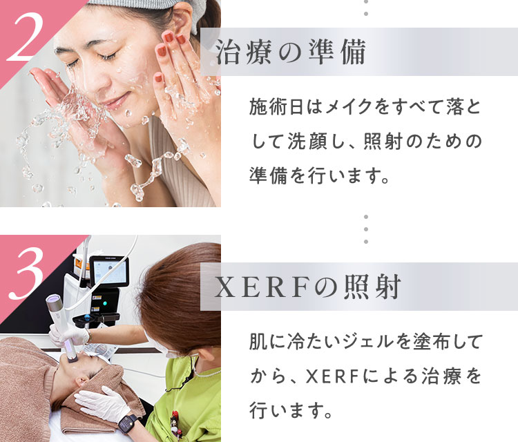 施術日はメイクをすべて落として洗顔し、照射のための準備を行います。